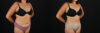Tummy Tuck case #7614 slider thumbnail