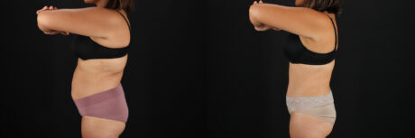 Tummy Tuck case #7614