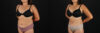 Tummy Tuck case #7614 slider thumbnail