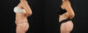 Tummy Tuck case #7613 slider thumbnail