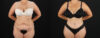 Tummy Tuck case #7613 slider thumbnail