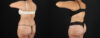 Tummy Tuck case #7613 slider thumbnail