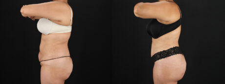 Tummy Tuck case #7613