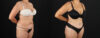 Tummy Tuck case #7613 slider thumbnail