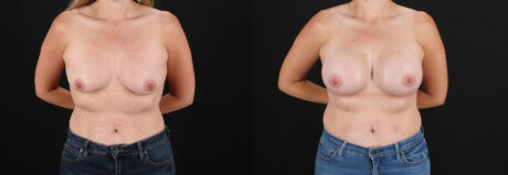 Breast Augmentation case #6438