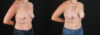 Breast Augmentation case #6438 slider thumbnail