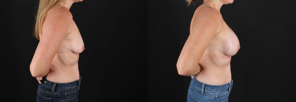 Breast Augmentation case #6438
