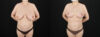 Breast Reduction case #7994 slider thumbnail