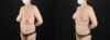 Breast Reduction case #7994 slider thumbnail