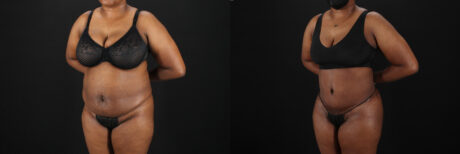 Tummy Tuck case #7620