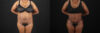 Tummy Tuck case #7620 slider thumbnail