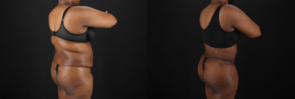 Tummy Tuck case #7620