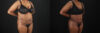 Tummy Tuck case #7620 slider thumbnail