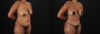 Tummy Tuck case #7619 slider thumbnail