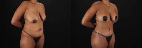 Tummy Tuck case #7619