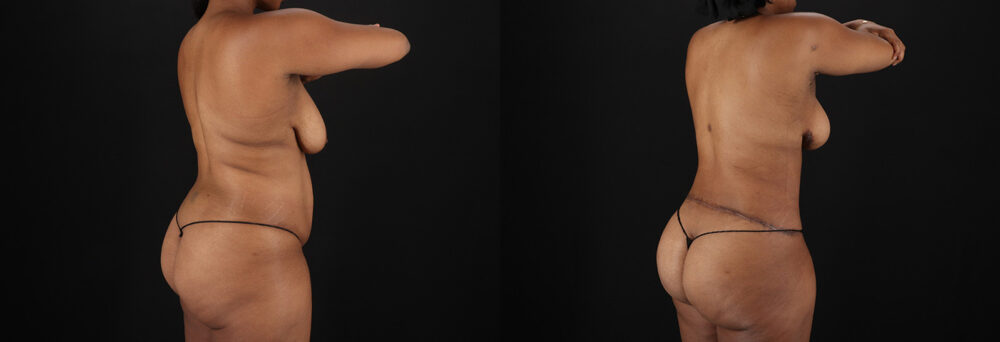 Tummy Tuck case #7619