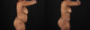 Tummy Tuck case #7619 slider thumbnail