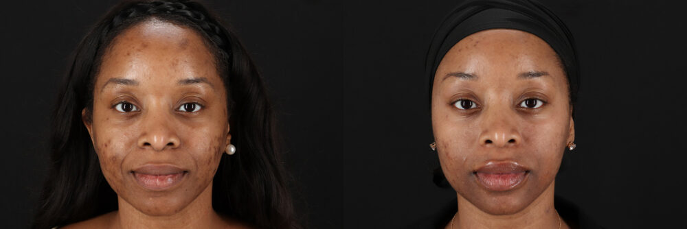 Cosmelan Chemical Peel case #5093