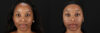 Cosmelan Chemical Peel case #5093 slider thumbnail