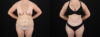 Mommy Makeover case #6686 slider thumbnail