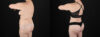 Mommy Makeover case #6686 slider thumbnail