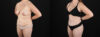 Mommy Makeover case #6686 slider thumbnail