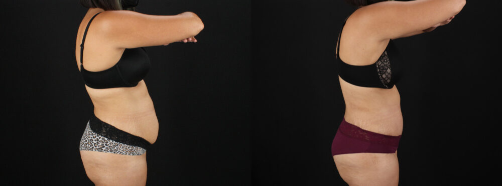 Tummy Tuck case #7617