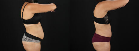 Tummy Tuck case #7617
