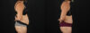 Tummy Tuck case #7617 slider thumbnail
