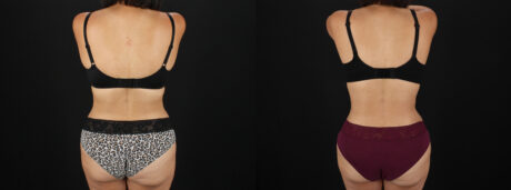 Tummy Tuck case #7617
