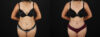Tummy Tuck case #7617 slider thumbnail