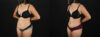 Tummy Tuck case #7617 slider thumbnail