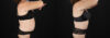 Tummy Tuck case #7624 slider thumbnail