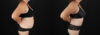 Tummy Tuck case #7624 slider thumbnail