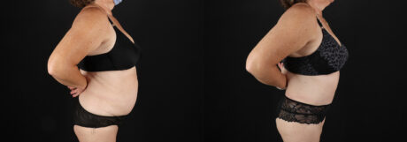 Tummy Tuck case #7624