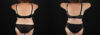 Tummy Tuck case #7624 slider thumbnail
