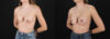 Revision Breast Surgery case #256261 slider thumbnail