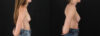 Revision Breast Surgery case #256261 slider thumbnail