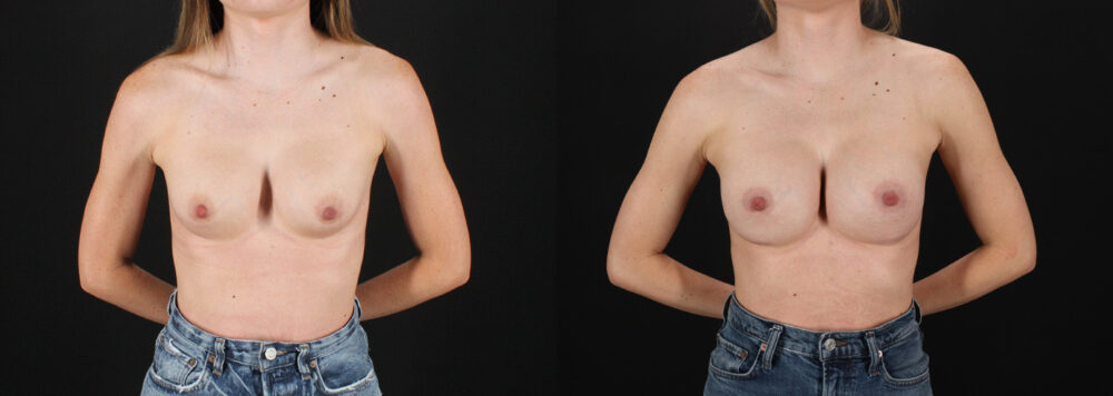 Revision Breast Surgery case #256261