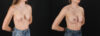 Revision Breast Surgery case #256261 slider thumbnail