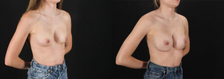 Revision Breast Surgery case #256261