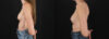 Revision Breast Surgery case #256261 slider thumbnail