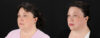 Profound RF Skin Tightening case #6907 slider thumbnail