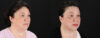 Profound RF Skin Tightening case #6907 slider thumbnail