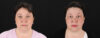 Profound RF Skin Tightening case #6907 slider thumbnail