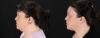 Profound RF Skin Tightening case #6907 slider thumbnail