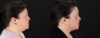 Profound RF Skin Tightening case #6907 slider thumbnail