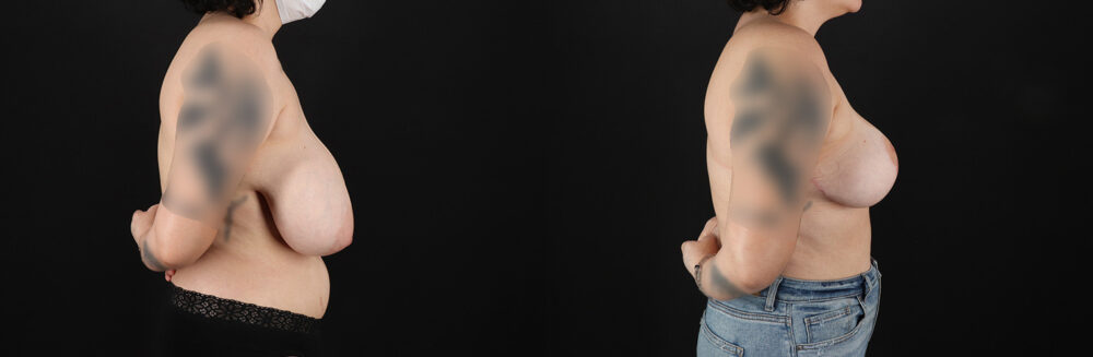 Breast Reduction case #8006
