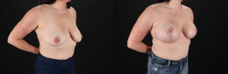 Breast Lift with Implants case #7897