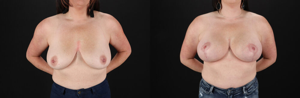 Breast Lift with Implants case #7897